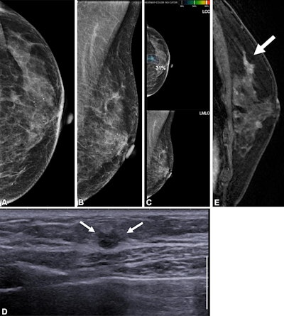 Images depict a 65-year-old patient with contralateral second breast cancer 6.3 years after right mastectomy. (A) Left craniocaudal and (B) mediolateral oblique mammograms assessed as benign. (C) The AI algorithm outlined a lesion with a score of 31 on the craniocaudal view. (D) A supplemental axial ultrasound scan, which was obtained on the same day as the mammogram, shows an irregular hypoechoic mass (arrows) in the left upper central breast. (E) Preoperative sagittal contrast-enhanced T1-weighted MRI scan shows the corresponding enhancing mass (arrow) in the left upper center. The mass was proven to be ductal carcinoma in situ.