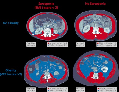 Example CT scans show skeletal muscle and visceral adipose tissue (VAT) area measurements in four patients with a similar body mass index (BMI), calculated as patient weight in kilograms divided by patient height in meters squared, at the L3 vertebral level, along with corresponding skeletal muscle index (SMI) and VAT t-scores. Images and caption courtesy of the RSNA.