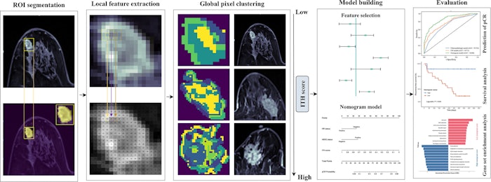 MRI Nomogram Predicts Breast Cancer Treatment
