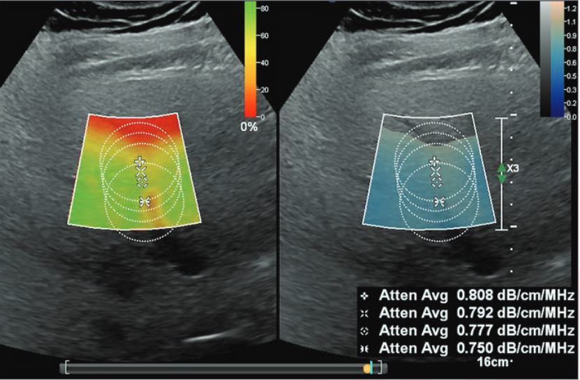 Ultrasound images depict a 56-year-old man with obesity (body mass index, 42) and steatosis (MRI-PDFF, 10.4%), who underwent ultrasound attenuation coefficient (AC) measurement due to participation in the present study. The unit displays color-coded confidence map (left) and AC map (on right) in side-by-side manner. The confidence map indicates quality of acquired AC signals and is set like traffic lights: green indicates good quality acquisition, yellow indicates warning, and red indicates low quality. Areas with low quality are left blank on the AC map. The image shows multiple circular ROIs placed at depths below the liver capsule of 2, 2.5, 3, and 4 cm. All ROIs are 3.5 cm in size. The confidence map threshold is set at 20%. AC measurements (in units of dB/cm/MHz) were extracted from all ROIs (excluding voxels without assigned color on the AC map) and decrease with greater ROI depth.
