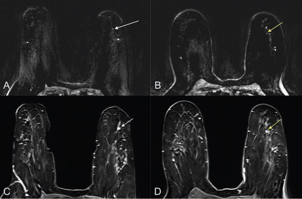 (A) Ultrafast MR image obtained 14 seconds after aortic enhancement shows 0.4-cm focus (arrow) in the left breast at 3-o&rsquo;clock position, 4.5 cm from index cancer (not shown). (B) Ultrafast MR image obtained 23 seconds after aortic enhancement shows wash-in (arrow) of background parenchymal enhancement (BPE). (C) and (D) On first standard postcontrast subtraction MR images, focus (arrow, C) and BPE (arrow, D) are indistinguishable. MRI-guided biopsy of focus yielded grade 2 invasive lobular carcinoma. Image courtesy of the ARRS.