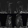 (A) Ultrafast MR image obtained 14 seconds after aortic enhancement shows 0.4-cm focus (arrow) in the left breast at 3-o’clock position, 4.5 cm from index cancer (not shown). (B) Ultrafast MR image obtained 23 seconds after aortic enhancement shows wash-in (arrow) of background parenchymal enhancement (BPE). (C) and (D) On first standard postcontrast subtraction MR images, focus (arrow, C) and BPE (arrow, D) are indistinguishable. MRI-guided biopsy of focus yielded grade 2 invasive lobular carcinoma. Image courtesy of the ARRS.