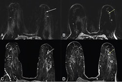 (A) Ultrafast MR image obtained 14 seconds after aortic enhancement shows 0.4-cm focus (arrow) in the left breast at 3-o’clock position, 4.5 cm from index cancer (not shown). (B) Ultrafast MR image obtained 23 seconds after aortic enhancement shows wash-in (arrow) of background parenchymal enhancement (BPE). (C) and (D) On first standard postcontrast subtraction MR images, focus (arrow, C) and BPE (arrow, D) are indistinguishable. MRI-guided biopsy of focus yielded grade 2 invasive lobular carcinoma. Image courtesy of the ARRS.