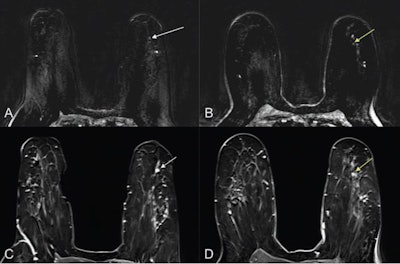 (A) Ultrafast MR image obtained 14 seconds after aortic enhancement shows 0.4-cm focus (arrow) in the left breast at 3-o’clock position, 4.5 cm from index cancer (not shown). (B) Ultrafast MR image obtained 23 seconds after aortic enhancement shows wash-in (arrow) of background parenchymal enhancement (BPE). (C) and (D) On first standard postcontrast subtraction MR images, focus (arrow, C) and BPE (arrow, D) are indistinguishable. MRI-guided biopsy of focus yielded grade 2 invasive lobular carcinoma. Image courtesy of the ARRS.
