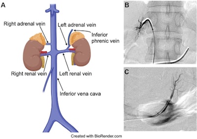 Images show adrenal vein sampling. (A) Schematic representation shows anatomy of the adrenal veins (created with BioRender.com). (B, C) Venograms obtained during the procedure show (B) right adrenal vein and (C) left adrenal vein. Two separate catheters were used to cannulate the right and left adrenal veins. The vein locations were visually confirmed using adrenal venography and occasional adjunctive cone-beam CT. Image and caption courtesy of RSNA.