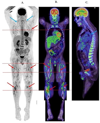(A) Whole-body F-18 FDG-PET maximal intensity projection image demonstrating widespread medium vessel vasculitis predominantly involving both lower limbs (thighs and proximal calves) and much lesser proximal upper limbs/axillae (red arrows). Moderate FDG uptake in bilateral cervical nodes also demonstrated (blue arrows). Horizontal red lines depict different trans-axial slice levels. (B) Whole body F-18 FDG-PET/CT coronal fused images demonstrating medium vessel vasculitis involving bilateral femoral and popliteal vessels and numerous smaller branches throughout the thighs and proximal calves (red arrows). Horizontal red lines depict different trans-axial slice levels. (C) Whole-body F-18 FDG-PET/CT sagittal fused images demonstrating no abnormal FDG uptake in the ascending or descending thoracic aorta (blue arrow). Image and caption available for republishing under Creative Commons license (CC BY 4.0 DEED, Attribution 4.0 International) and courtesy of EJNMMI Reports.