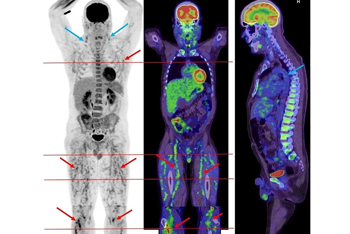 Covid 19 Vax Thumbnail