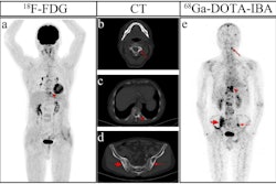 Images of a 69-year-old man diagnosed with prostate cancer who had a history of endocrine therapy for two years. (a) The maximum intensity projection (MIP) image of F-18 FDG showed moderate radiotracer uptake in a thoracic vertebra. (e) The MIP image of Ga-68 DOTA-IBA demonstrated more lesions in the cervical vertebra and pelvis. (b) An osteoblastic lesion in the C3 vertebra right attachment (curved arrows) was negative on F-18 FDG (SUVmax = 2.0) and positive on Ga-68 DOTA-IBA (SUVmax = 8.7). (c) Another osteoblastic lesion in the T10 vertebra left side (arrowheads) was both positive on F-18 FDG (SUVmax = 5.2) and positive on Ga-68 DOTA-IBA (SUVmax = 35.0). (d) Osteoblastic lesions in bilateral ilium (dotted arrows and arrows) were negative on F-18 FDG (left: SUVmax = 1.4, right: SUVmax = 1.6) and positive on Ga-68 DOTA-IBA (left: SUVmax = 7.6, right: SUVmax = 8.7). Follow-up imaging three months later confirmed the presence of these bone metastases. Image and caption available for republishing under Creative Commons license (CC BY 4.0 DEED, Attribution 4.0 International) and courtesy of Scientific Reports.
