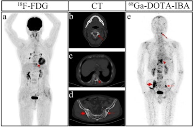 PET CT Scans Reveal Hidden Risks of Giant Cell Arteritis and Occult Cancer in PMR