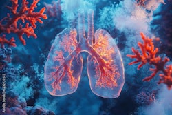 Lung Cancer
