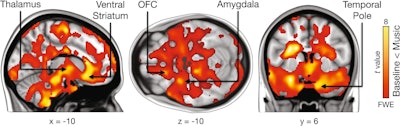 Regions showing increased carbon-11 (C-11) carfentanil binding during music listening relative to neutral baseline. The data are thresholded at p