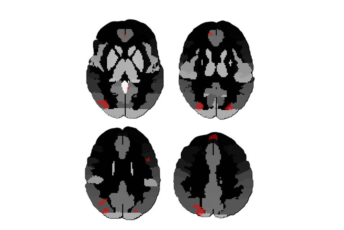 Resting-state fMRI analysis reveals impact of blast exposures