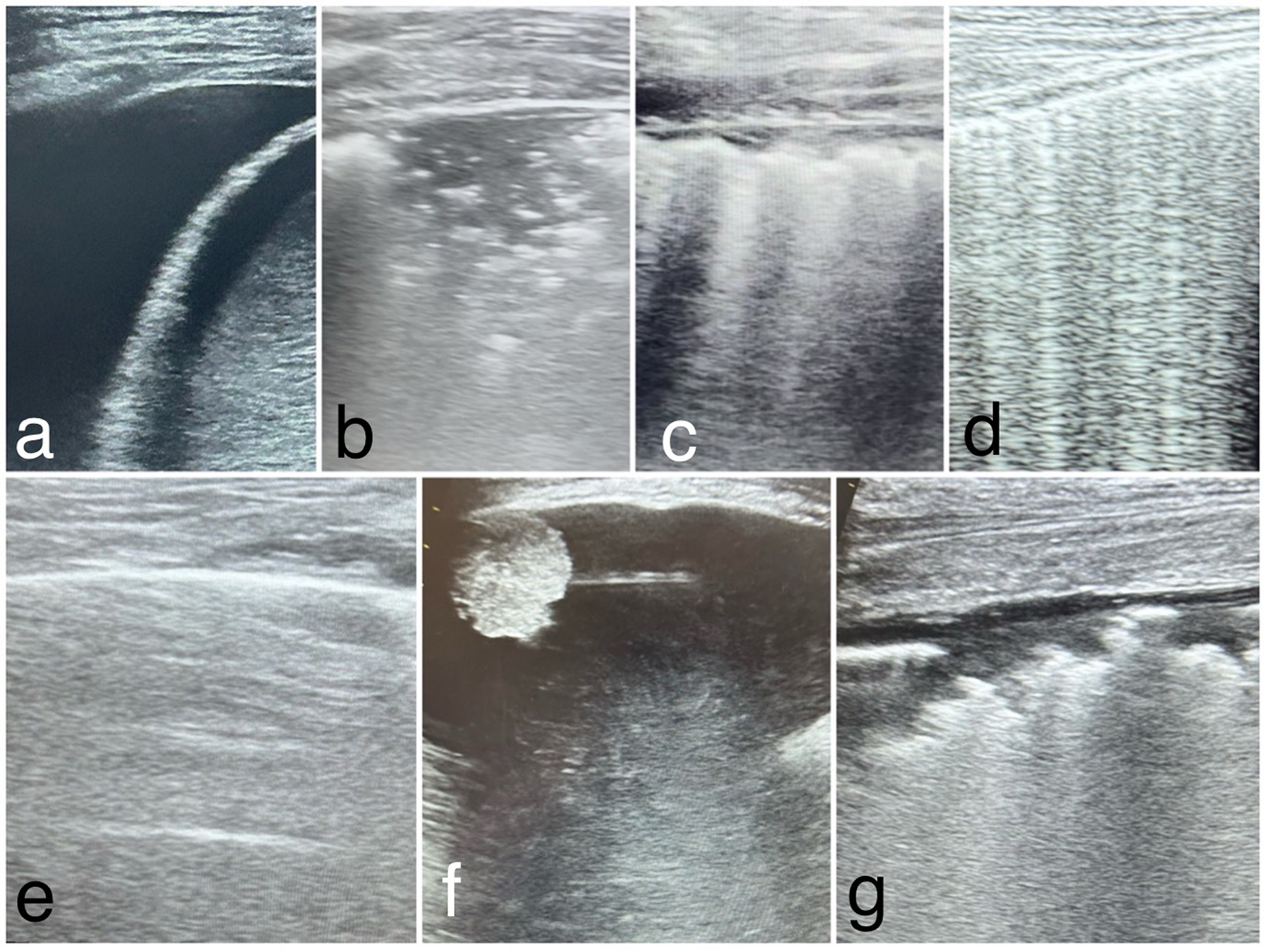 Images show lung ultrasound findings of major pleuro-pulmonary pathologies. (a) Pleural effusion; (b) Pneumonia; (c) Bronchopneumonia; (d) Acute pulmonary edema; (e) Chronic obstructive pulmonary disease exacerbation; (f) Pleuropulmonary tumors; (g) Acute respiratory distress syndrome.
