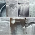 Images show lung ultrasound findings of major pleuro-pulmonary pathologies. (a) Pleural effusion; (b) Pneumonia; (c) Bronchopneumonia; (d) Acute pulmonary edema; (e) Chronic obstructive pulmonary disease exacerbation; (f) Pleuropulmonary tumors; (g) Acute respiratory distress syndrome.