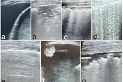 Images show lung ultrasound findings of major pleuro-pulmonary pathologies. (a) Pleural effusion; (b) Pneumonia; (c) Bronchopneumonia; (d) Acute pulmonary edema; (e) Chronic obstructive pulmonary disease exacerbation; (f) Pleuropulmonary tumors; (g) Acute respiratory distress syndrome.