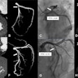 Representative images from diagnostic analysis of deep learning (DL)-based CT myocardial perfusion imaging (MPI). (A-D) Representative images in a 51-year-old woman with stable angina at presentation. (A) Curved planar reformation and (B) three-dimensional maximum intensity projection images show severe stenosis of the opening left anterior descending artery (arrow). (C) Fractional flow reserve (FFR) determined with invasive coronary angiography helps confirm that there was no hemodynamic significance of the opening left anterior descending artery lesion (arrow). (D) Dynamic CT MPI provided functional information to identify hemodynamically significant stenosis with reference to invasive FFR. Myocardial blood flow (MBF) derived from DL-based CT MPI revealed the absence of decreased myocardial perfusion of the left anterior descending artery territory (the areas outlined in black represent the myocardium subtended by the left anterior descending stenosis, and the color bar is a graphical scale that maps MBF ranges). (E-H) Representative images in a 62-year-old man with exertional chest pain at presentation. (E) Curved planar reformation and (F) three-dimensional maximum intensity projection images show moderate stenosis of the middle left anterior descending artery (arrow). (G) FFR determined at invasive coronary angiography helps confirm that the middle left anterior descending lesion was hemodynamically significant (arrow). (H) Dynamic CT MPI provided functional information to identify hemodynamically significant stenosis with reference to invasive FFR. DL-based CT MPI showed a reduction in MBF within the middle and basal anterior wall of the left anterior descending artery territory (the areas outlined in black represent the myocardium with decreased perfusion, and the color bar is a graphical scale that maps MBF ranges). MBFDL = MBF derived from the DL model.