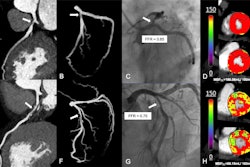 Representative images from diagnostic analysis of deep learning (DL)-based CT myocardial perfusion imaging (MPI). (A-D) Representative images in a 51-year-old woman with stable angina at presentation. (A) Curved planar reformation and (B) three-dimensional maximum intensity projection images show severe stenosis of the opening left anterior descending artery (arrow). (C) Fractional flow reserve (FFR) determined with invasive coronary angiography helps confirm that there was no hemodynamic significance of the opening left anterior descending artery lesion (arrow). (D) Dynamic CT MPI provided functional information to identify hemodynamically significant stenosis with reference to invasive FFR. Myocardial blood flow (MBF) derived from DL-based CT MPI revealed the absence of decreased myocardial perfusion of the left anterior descending artery territory (the areas outlined in black represent the myocardium subtended by the left anterior descending stenosis, and the color bar is a graphical scale that maps MBF ranges). (E-H) Representative images in a 62-year-old man with exertional chest pain at presentation. (E) Curved planar reformation and (F) three-dimensional maximum intensity projection images show moderate stenosis of the middle left anterior descending artery (arrow). (G) FFR determined at invasive coronary angiography helps confirm that the middle left anterior descending lesion was hemodynamically significant (arrow). (H) Dynamic CT MPI provided functional information to identify hemodynamically significant stenosis with reference to invasive FFR. DL-based CT MPI showed a reduction in MBF within the middle and basal anterior wall of the left anterior descending artery territory (the areas outlined in black represent the myocardium with decreased perfusion, and the color bar is a graphical scale that maps MBF ranges). MBFDL = MBF derived from the DL model.