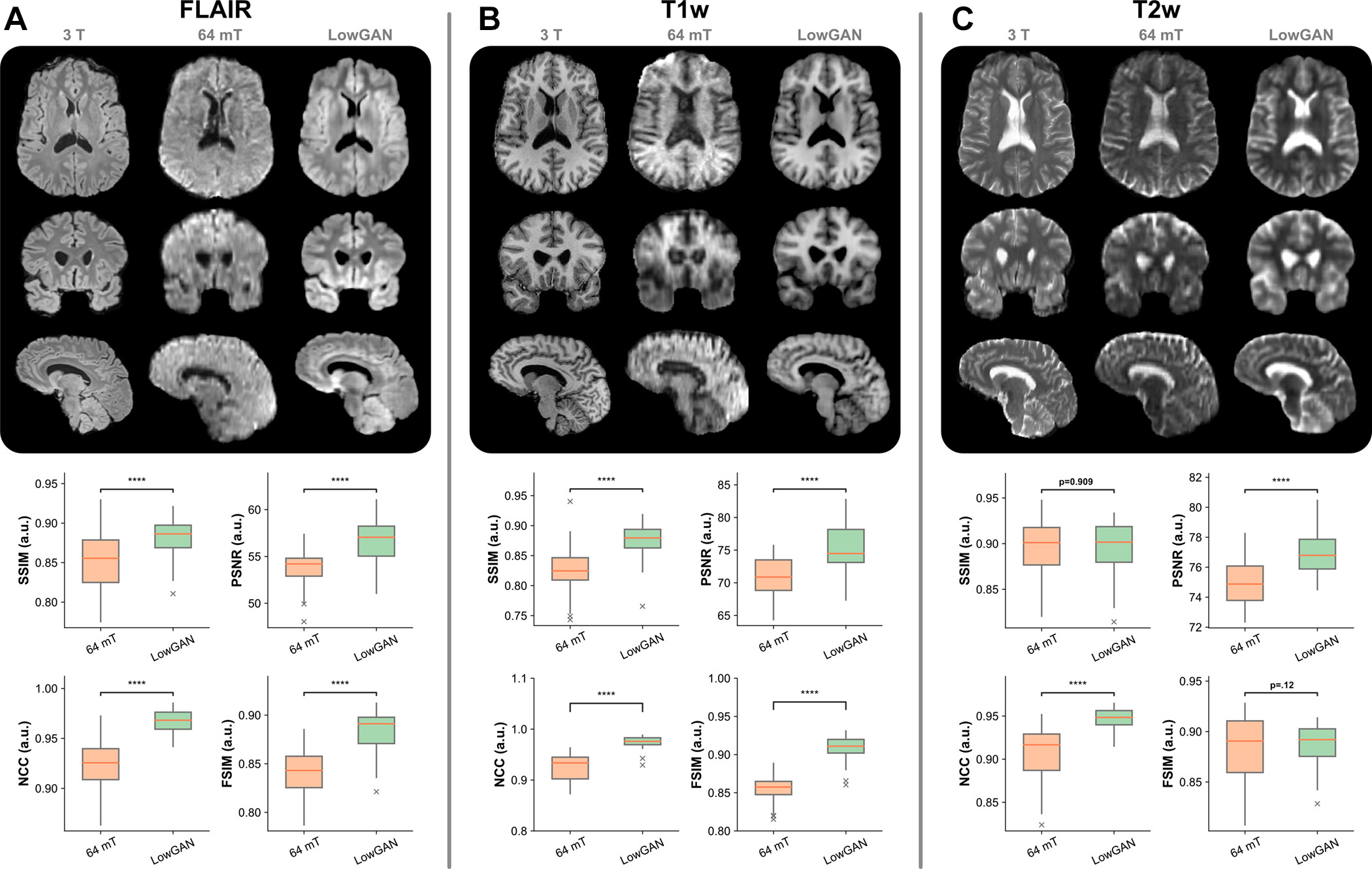 Figure: Improved image quality with a generative adversarial network architecture for low- to high-field-strength image translation, called LowGAN. (A&ndash;C) Top: High-field-strength (3-T) and low-field-strength (64-mT) images and LowGAN outputs for a single participant across (A) fluid-attenuated inversion recovery (FLAIR), (B) T1-weighted (T1w), and (C) T2-weighted (T2w) contrasts. Bottom: Graphs demonstrate the structural similarity index (SSIM), peak signal-to-noise ratio (PSNR), normalized cross-correlation (NCC), and feature similarity index (FSIM) between high field strength and low field strength (64-mT) and high field strength and LowGAN outputs. a.u. = arbitrary units.****p &le; 0.0001. Images and caption courtesy of Radiology and the RSNA.