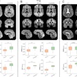 Figure: Improved image quality with a generative adversarial network architecture for low- to high-field-strength image translation, called LowGAN. (A–C) Top: High-field-strength (3-T) and low-field-strength (64-mT) images and LowGAN outputs for a single participant across (A) fluid-attenuated inversion recovery (FLAIR), (B) T1-weighted (T1w), and (C) T2-weighted (T2w) contrasts. Bottom: Graphs demonstrate the structural similarity index (SSIM), peak signal-to-noise ratio (PSNR), normalized cross-correlation (NCC), and feature similarity index (FSIM) between high field strength and low field strength (64-mT) and high field strength and LowGAN outputs. a.u. = arbitrary units.****p ≤ 0.0001. Images and caption courtesy of Radiology and the RSNA.