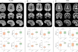 Figure: Improved image quality with a generative adversarial network architecture for low- to high-field-strength image translation, called LowGAN. (A–C) Top: High-field-strength (3-T) and low-field-strength (64-mT) images and LowGAN outputs for a single participant across (A) fluid-attenuated inversion recovery (FLAIR), (B) T1-weighted (T1w), and (C) T2-weighted (T2w) contrasts. Bottom: Graphs demonstrate the structural similarity index (SSIM), peak signal-to-noise ratio (PSNR), normalized cross-correlation (NCC), and feature similarity index (FSIM) between high field strength and low field strength (64-mT) and high field strength and LowGAN outputs. a.u. = arbitrary units.****p ≤ 0.0001. Images and caption courtesy of Radiology and the RSNA.