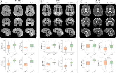 Figure: Improved image quality with a generative adversarial network architecture for low- to high-field-strength image translation, called LowGAN. (A–C) Top: High-field-strength (3-T) and low-field-strength (64-mT) images and LowGAN outputs for a single participant across (A) fluid-attenuated inversion recovery (FLAIR), (B) T1-weighted (T1w), and (C) T2-weighted (T2w) contrasts. Bottom: Graphs demonstrate the structural similarity index (SSIM), peak signal-to-noise ratio (PSNR), normalized cross-correlation (NCC), and feature similarity index (FSIM) between high field strength and low field strength (64-mT) and high field strength and LowGAN outputs. a.u. = arbitrary units.****p ≤ 0.0001. Images and caption courtesy of Radiology and the RSNA.