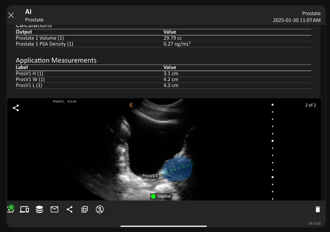Clarius Prostate AI measures prostate volume from ultrasound exams.