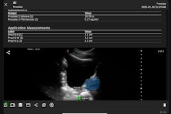 Clarius Prostate AI measures prostate volume from ultrasound exams.