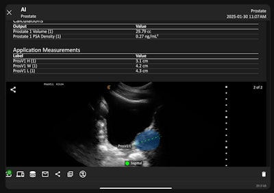 Clarius Prostate AI measures prostate volume from ultrasound exams.
