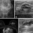 Images show a palpable mass in the left breast in a 55-year-old woman. (A) Mammography shows a 26-mm ill-defined mass with fine linear calcifications in the central portion of the left breast (arrows). (B) ultrasound shows a 23-mm hypoechoic mass with calcifications in the corresponding area accompanying palpability (between the arrows). (C) An axial, fat-saturated, contrast-enhanced T1-weighted MRI scan shows an 18-mm irregular heterogeneous enhancing mass in the left breast (arrows). After breast-conserving surgery, the final pathologic report confirmed a grade II estrogen receptor–negative, progesterone receptor–negative, human epidermal growth factor receptor 2–positive invasive ductal carcinoma. There was no lymphovascular invasion, and the resection margins were clear. The patient declined both adjuvant chemotherapy and radiation therapy due to psychologic distress. (D) 11 months later, surveillance ultrasound helped to detect a new 25-mm irregular hypoechoic mass at the 12-o’clock position in the left breast (arrows). A subsequent ultrasound-guided biopsy confirmed it as a recurrence of grade II invasive ductal carcinoma, maintaining the same receptor statuses. Images courtesy of the RSNA.