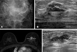 Images show a palpable mass in the left breast in a 55-year-old woman. (A) Mammography shows a 26-mm ill-defined mass with fine linear calcifications in the central portion of the left breast (arrows). (B) ultrasound shows a 23-mm hypoechoic mass with calcifications in the corresponding area accompanying palpability (between the arrows). (C) An axial, fat-saturated, contrast-enhanced T1-weighted MRI scan shows an 18-mm irregular heterogeneous enhancing mass in the left breast (arrows). After breast-conserving surgery, the final pathologic report confirmed a grade II estrogen receptor–negative, progesterone receptor–negative, human epidermal growth factor receptor 2–positive invasive ductal carcinoma. There was no lymphovascular invasion, and the resection margins were clear. The patient declined both adjuvant chemotherapy and radiation therapy due to psychologic distress. (D) 11 months later, surveillance ultrasound helped to detect a new 25-mm irregular hypoechoic mass at the 12-o’clock position in the left breast (arrows). A subsequent ultrasound-guided biopsy confirmed it as a recurrence of grade II invasive ductal carcinoma, maintaining the same receptor statuses. Images courtesy of the RSNA.