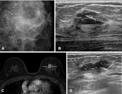 Images show a palpable mass in the left breast in a 55-year-old woman. (A) Mammography shows a 26-mm ill-defined mass with fine linear calcifications in the central portion of the left breast (arrows). (B) ultrasound shows a 23-mm hypoechoic mass with calcifications in the corresponding area accompanying palpability (between the arrows). (C) An axial, fat-saturated, contrast-enhanced T1-weighted MRI scan shows an 18-mm irregular heterogeneous enhancing mass in the left breast (arrows). After breast-conserving surgery, the final pathologic report confirmed a grade II estrogen receptor–negative, progesterone receptor–negative, human epidermal growth factor receptor 2–positive invasive ductal carcinoma. There was no lymphovascular invasion, and the resection margins were clear. The patient declined both adjuvant chemotherapy and radiation therapy due to psychologic distress. (D) 11 months later, surveillance ultrasound helped to detect a new 25-mm irregular hypoechoic mass at the 12-o’clock position in the left breast (arrows). A subsequent ultrasound-guided biopsy confirmed it as a recurrence of grade II invasive ductal carcinoma, maintaining the same receptor statuses. Images courtesy of the RSNA.