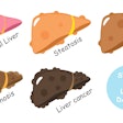 Liver Disease Stages