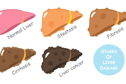 Liver Disease Stages