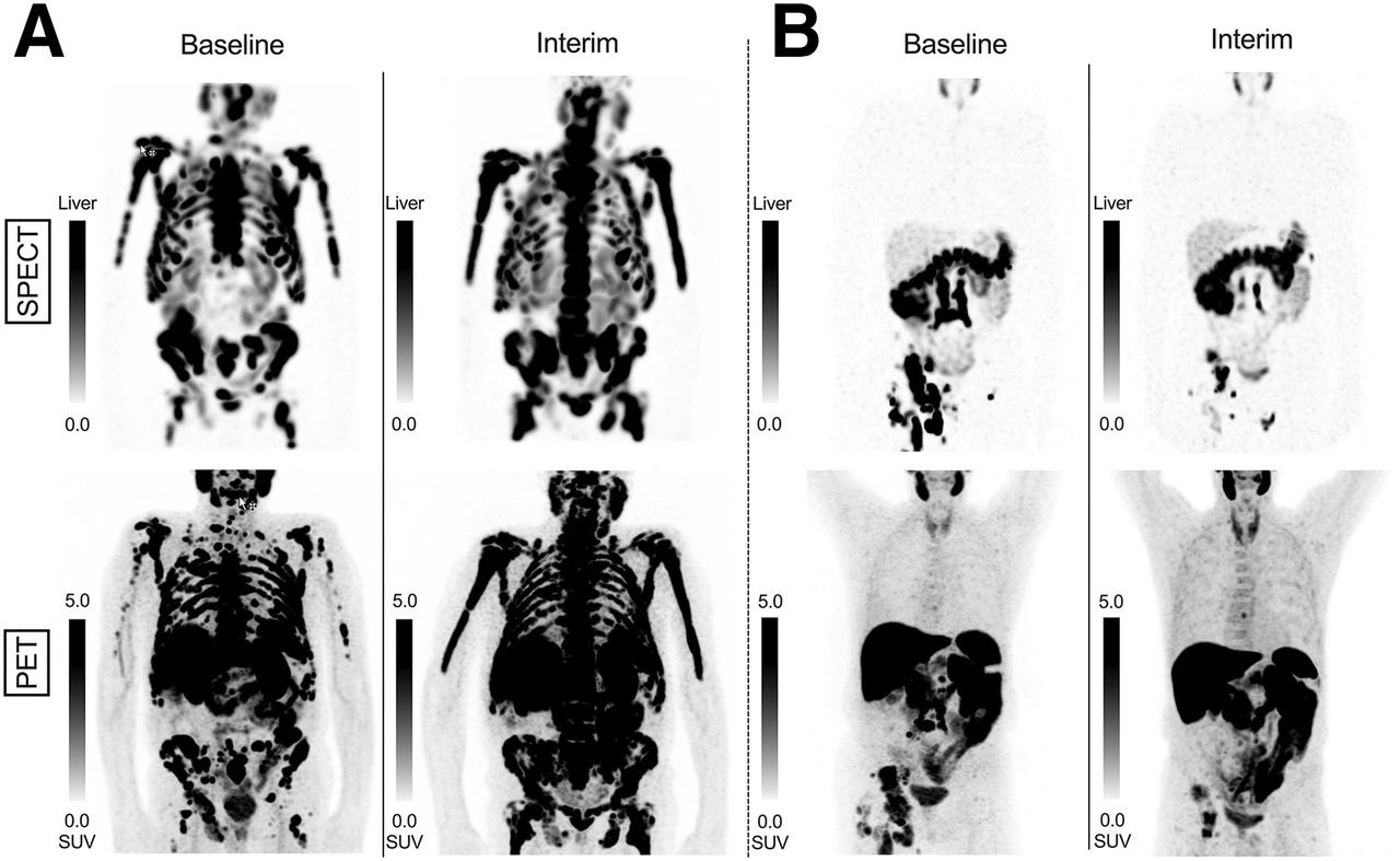 Patient examples of SPECT/CT and PET/CT RECIP 1.0. (A) SPECT and PET maximum-intensity projection (MIP) images in 74-year-old man with mCRPC. Serum PSA level at baseline was 449 ng/mL and slightly increased to 525 ng/mL after two cycles of Lu-177 PSMA. Eastern Cooperative Oncology Group (ECOG) score was 2 at baseline and increased to 3 after 2 cycles. The patient was classified by readers as RECIP-progressive disease on both SPECT and PET. Overall survival was 4.7 months. Two cycles of Lu-177 PSMA were administered. (B) SPECT and PET MIP images in 74-year-old man with mCRPC. Serum PSA level was 231 ng/mL at baseline and decreased to 12.5 ng/mL after 2 cycles of Lu-177 PSMA. ECOG score was less than 2 at baseline and after 2 cycles of Lu-177 PSMA. The patient was classified by readers as RECIP-partial response on both SPECT and PET. Overall survival was 14.3 months. Four cycles of Lu-177 PSMA were administered.