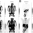Patient examples of SPECT/CT and PET/CT RECIP 1.0. (A) SPECT and PET maximum-intensity projection (MIP) images in 74-year-old man with mCRPC. Serum PSA level at baseline was 449 ng/mL and slightly increased to 525 ng/mL after two cycles of Lu-177 PSMA. Eastern Cooperative Oncology Group (ECOG) score was 2 at baseline and increased to 3 after 2 cycles. The patient was classified by readers as RECIP-progressive disease on both SPECT and PET. Overall survival was 4.7 months. Two cycles of Lu-177 PSMA were administered. (B) SPECT and PET MIP images in 74-year-old man with mCRPC. Serum PSA level was 231 ng/mL at baseline and decreased to 12.5 ng/mL after 2 cycles of Lu-177 PSMA. ECOG score was less than 2 at baseline and after 2 cycles of Lu-177 PSMA. The patient was classified by readers as RECIP-partial response on both SPECT and PET. Overall survival was 14.3 months. Four cycles of Lu-177 PSMA were administered.