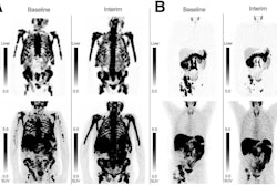Patient examples of SPECT/CT and PET/CT RECIP 1.0. (A) SPECT and PET maximum-intensity projection (MIP) images in 74-year-old man with mCRPC. Serum PSA level at baseline was 449 ng/mL and slightly increased to 525 ng/mL after two cycles of Lu-177 PSMA. Eastern Cooperative Oncology Group (ECOG) score was 2 at baseline and increased to 3 after 2 cycles. The patient was classified by readers as RECIP-progressive disease on both SPECT and PET. Overall survival was 4.7 months. Two cycles of Lu-177 PSMA were administered. (B) SPECT and PET MIP images in 74-year-old man with mCRPC. Serum PSA level was 231 ng/mL at baseline and decreased to 12.5 ng/mL after 2 cycles of Lu-177 PSMA. ECOG score was less than 2 at baseline and after 2 cycles of Lu-177 PSMA. The patient was classified by readers as RECIP-partial response on both SPECT and PET. Overall survival was 14.3 months. Four cycles of Lu-177 PSMA were administered.