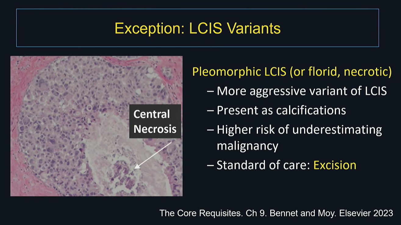 Amie Lee, MD, presented at ARRS 2025 on managing 'controversial' high-risk breast lesions diagnosed on core needle biopsy. This slide outlines how to manage pleomorphic lobular carcinoma in situ (LCIS) via surgical excision.