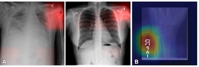 Example of learning to make a diagnosis based on spurious correlation [e.g., laterality marker], rather than the disease or condition itself. (A) Images from a deep learning (DL) model in radiology that can learn to identify confounding features related to bias and unfair predictions, including laterality markers (image annotations indicate the side of the body being viewed [right vs left]) to identify the hospital at which a chest radiograph was obtained. (B) Image from a DL model that can make a diagnosis of radiographic abnormality on extremity radiographs, also known as shortcut learning. A. Images adapted and reprinted from reference 57, an open-source article, published under the Creative Commons license (CC BY 4.0). B. Reprinted, with permission, from reference 59. All courtesy of the RSNA.