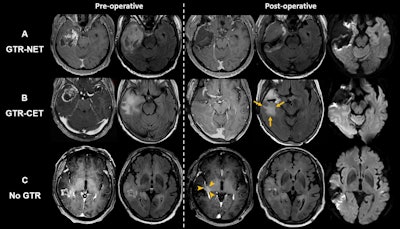 Axial MRI scans show extent-of-resection groups for (A) gross total resection (GTR) of both contrast-enhanced tumor (CET) and noncontrast-enhanced tumor (NET) (GTR-NET), (B) GTR of CET but NET remained (GTR-CET), and (C) no GTR. Scans show (B) residual T2 and fluid-attenuated inversion recovery (FLAIR) high-signal infiltrative tumor (arrows) and (C) residual CET around the surgical cavity (arrowheads). Diffusion-weighted imaging (right-side column) was used to differentiate residual T2-weighted or FLAIR signal hyperintensity as a result of NET from cytotoxic surgery-induced changes. Images and caption courtesy of the RSNA.