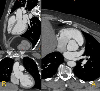 A 33-year-old man with Marfan syndrome and dilated aortic root. On the transverse images (A) the aorta measures 4.5 cm by 4.2 cm. When corrected for long axis (B) of the aorta, the aorta measures 3.9 cm by 4.2 cm. Measurements obtained orthogonal to the long axis of the aorta allow for consistent sizing and accurate risk assessment. Volume rendered image shows the root dilatation with mild effacement of the sinotubular junction (see below). This phenotype is sometimes referred to as annuloaortic ectasia, a characteristic finding of Marfan syndrome. Additional axial and coronal images of aortic dilation are provided (see below). All images courtesy of Sanjeev Bhalla, MD, and Mensur Koso, MD.