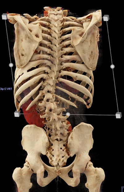 A 34-year-old man being followed after aortic repair. Cinematic rendering shows the marked scoliosis form a posterior view.