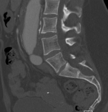 2025 05 09 Marfan Syndrome Image11
