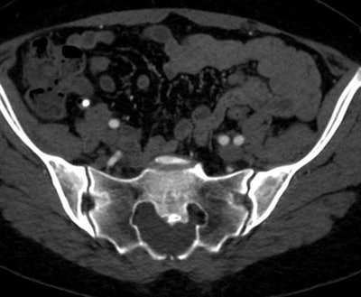 Same 39-year-old woman from above. More inferiorly dural ectasia can be seen with posterior scalloping of the sacrum typical of Marfan syndrome.
