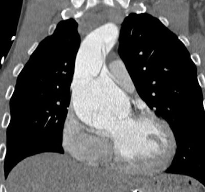 2025 05 09 Marfan Syndrome Image3