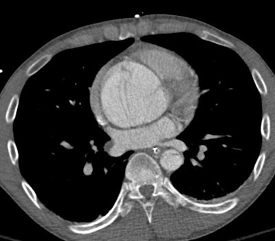 2025 05 09 Marfan Syndrome Image4