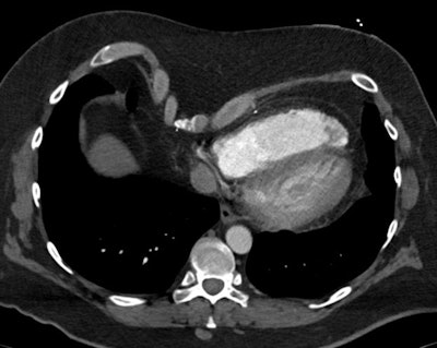 2025 05 09 Marfan Syndrome Image6