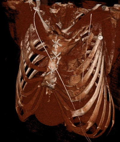 Severe pectus excavatum in a 24-year-old man with Marfan syndrome post ascending aortic repair.