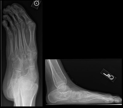 19-year-old man with foot findings that can be seen with Marfan syndrome including arachnodactyly and pes planus.