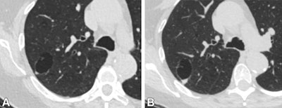 CT images in a 74-year-old female patient. (A) Axial image from a lung cancer screening shows a 3.1 cm by 2 cm unilocular cystic lesion with a 0.5 cm solid nodular component in the right upper lobe. The overall size of the lesion and solid nodular component ultimately grew. (B) Follow-up CT image obtained 37 months later, before resection, shows a 3.5 cm by 2.4-cm lesion with a 0.8-cm solid component. This lesion was pathologically proven to be invasive adenocarcinoma. Images and caption courtesy of the RSNA.