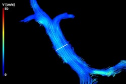 Velocity streamlines of the portal vein measured using 4D flow MRI in a cirrhosis patient (a 62-year-old male), shown at the cardiac cycle time t = 84 ms. A cut-plane (white marker) matching the 2D flow image plane was used to quantify the 4D flow parameters in the main portal vein.